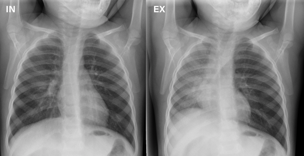 Airway Foreign Body