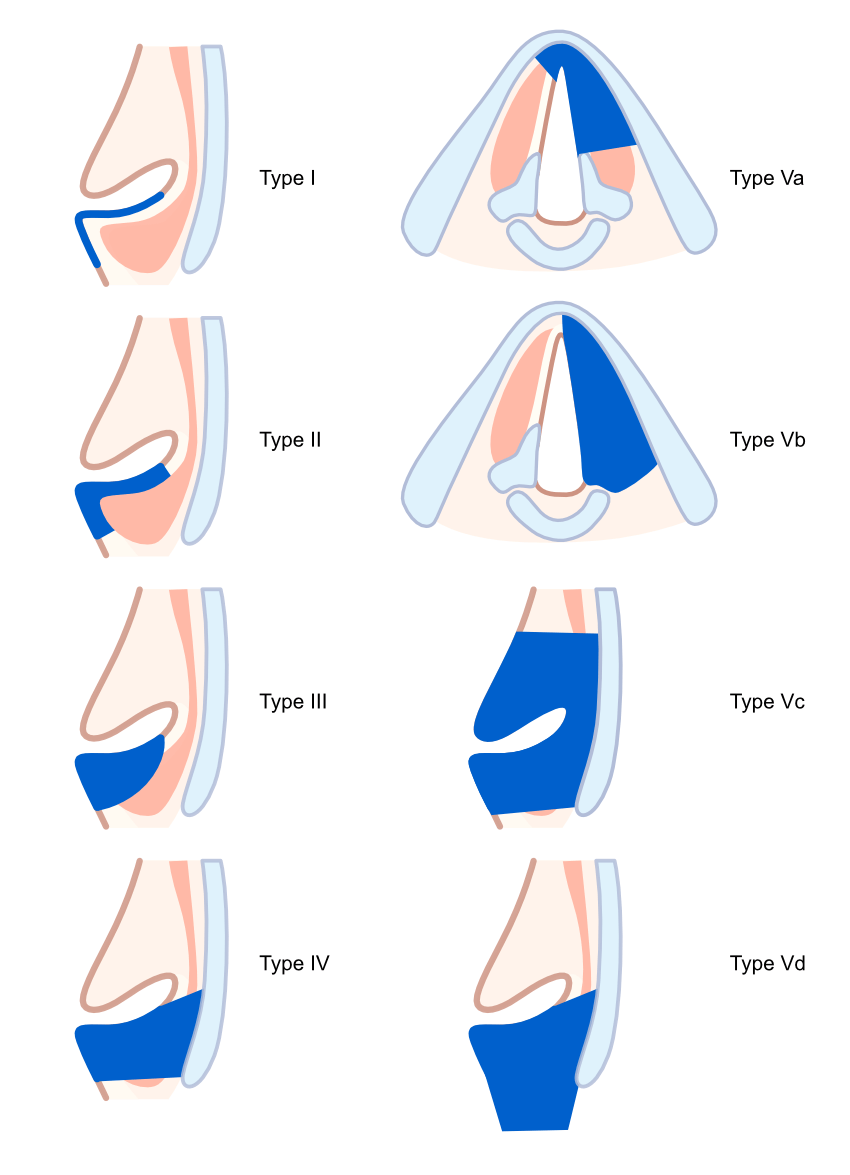 ELS Classification for Endoscopic Cordectomy