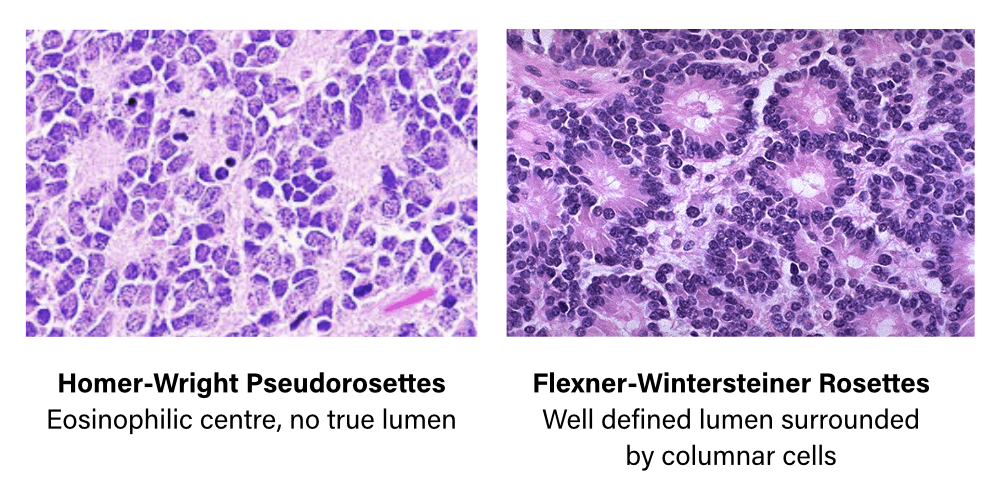 Homer Wright Pseudorosettes versus Flexner-Wintersteiner Rosettes