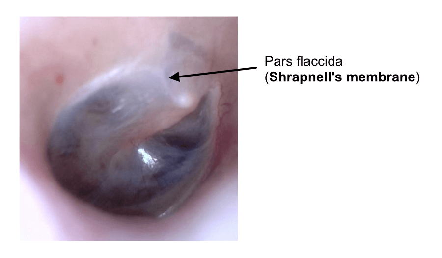 Shrapnell's membrane (pars flaccida)